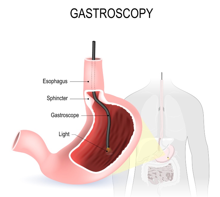 Gastroscopia: un esame importante (depositphotos) - ilcorrierino.com