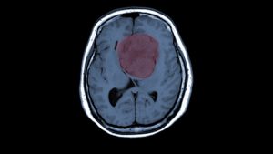 Tumore al cervello (depositphotos) - ilcorrierino.com