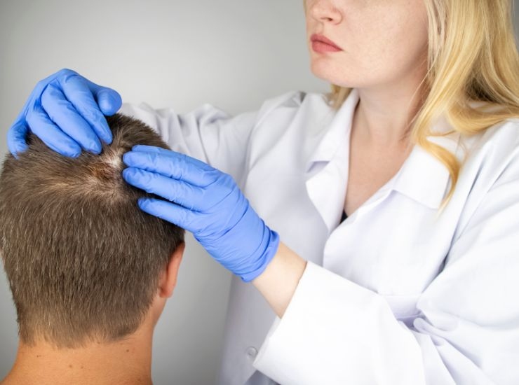 Costo trapianto di capelli